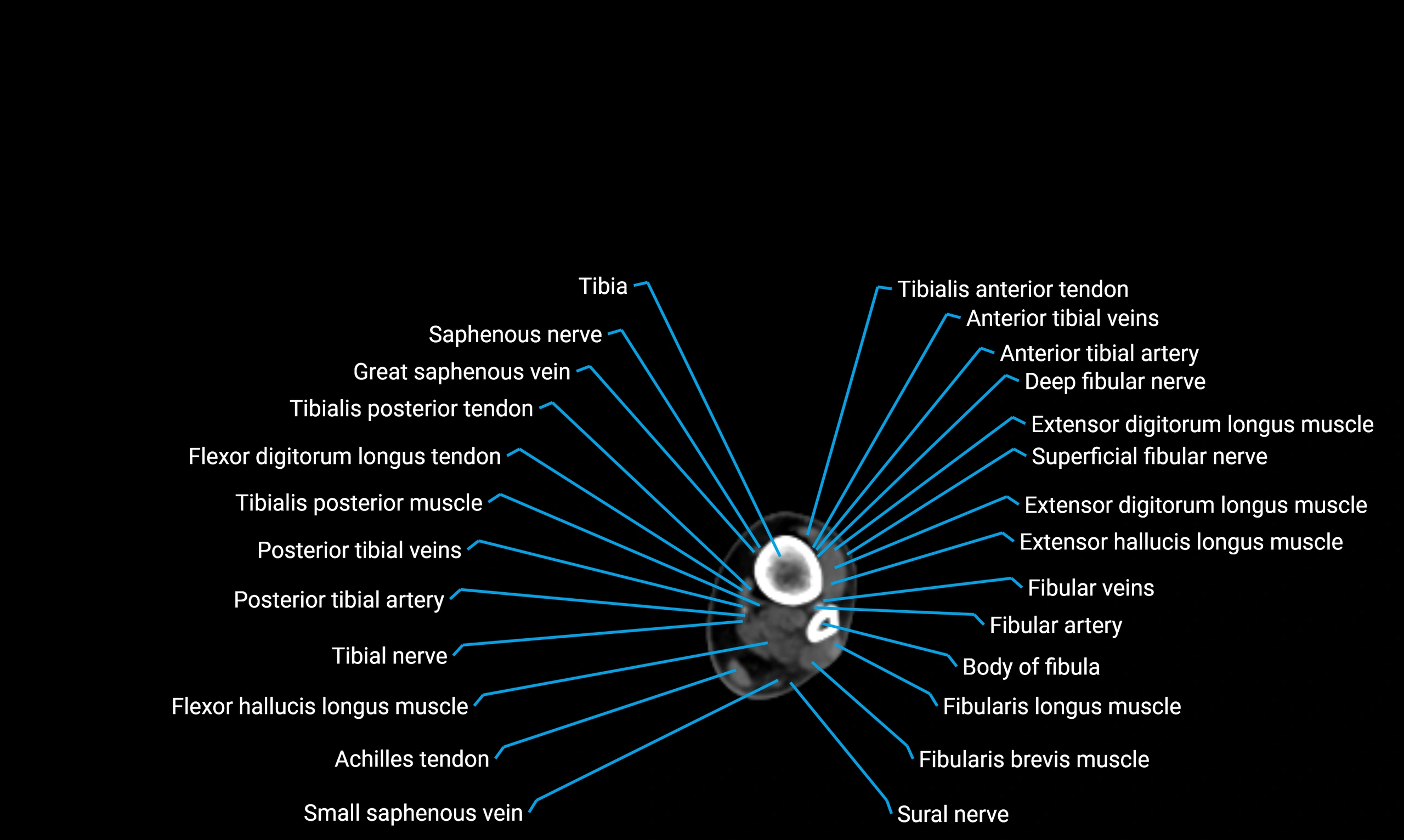CT lower limb axial cross sectional anatomy labelled image 158 (2).webp